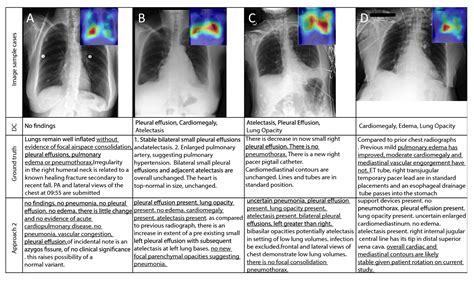 Ai Diagnoses Lung Disease Based On X Rays