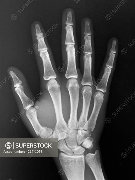 Normal Hand X Ray Of A Year Old Boy Superstock