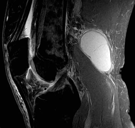 The Popliteal Fossa Borders Contents Teachmeanatomy