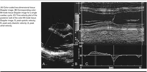 tissue doppler echocardiography current opinion  cardiology