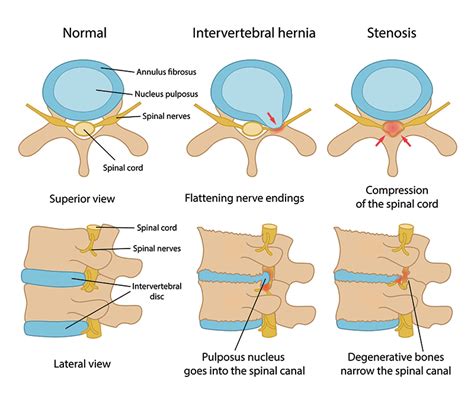 Spinal Stenosis Albuquerque Nm Modern Pain Spine