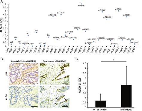 Mutant P53 Correlates With Elevated ALDH Levels In Patients With