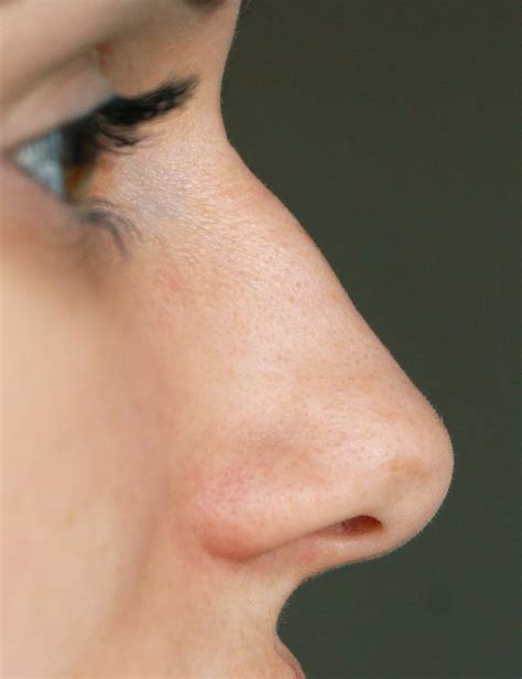 Nose Bump Overview Causes Treatment Options And More 57 Off