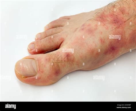 Close Up Of Male S Foot And Toes With Red Rash Desease On A White