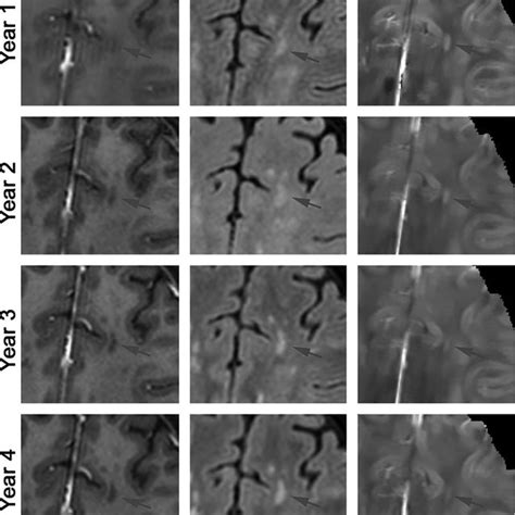 Longitudinal Qsm And T Weighted Flair Images Of A New Gd Enhancing Ms