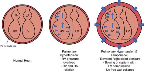 Figure 3 From Cardiac Tamponade In Severe Pulmonary Hypertension A