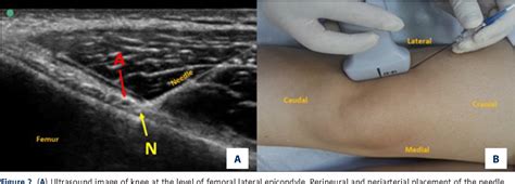 Figure 2 From The Efficacy Of Ultrasound Guided Pulsed Radiofrequency