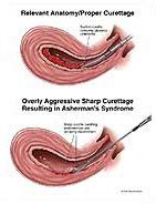 Curettage Medical Illustration Medivisuals