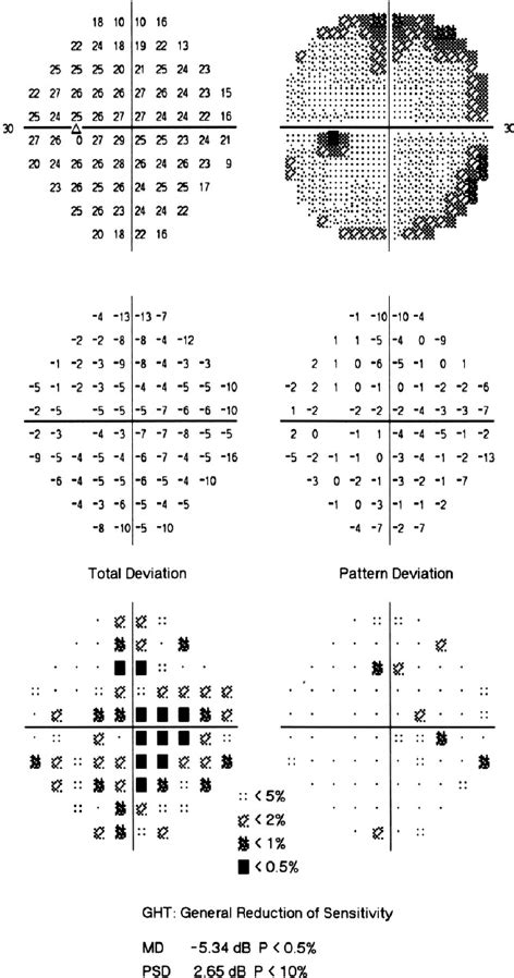 A Visual Field Printout Of An Eye With Suspect Glaucoma And Cataract