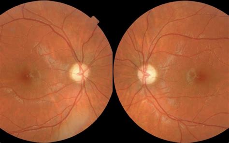 Juvenile Macular Degeneration Genetic Eyesight