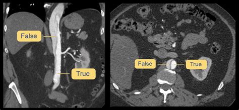 Abdominal Ct Phases Litfl Radiology Library