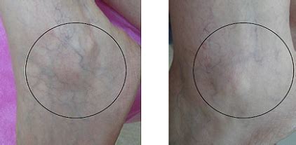 Slt Long Pulse Nd Yag Laser For The Treatment Of Leg Veins And Benign