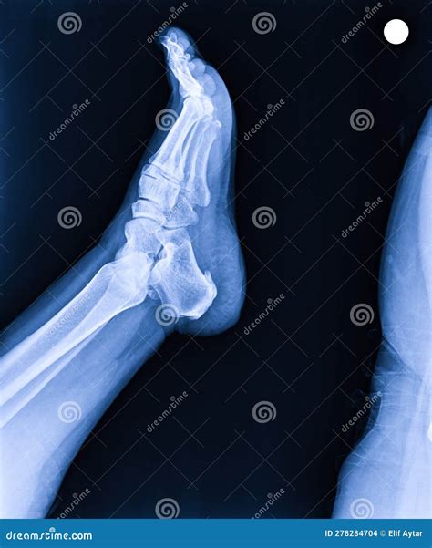 X-ray Normal Human S Foot Lateral Stock Photo - Image of rheumatoid, heels: 278284704