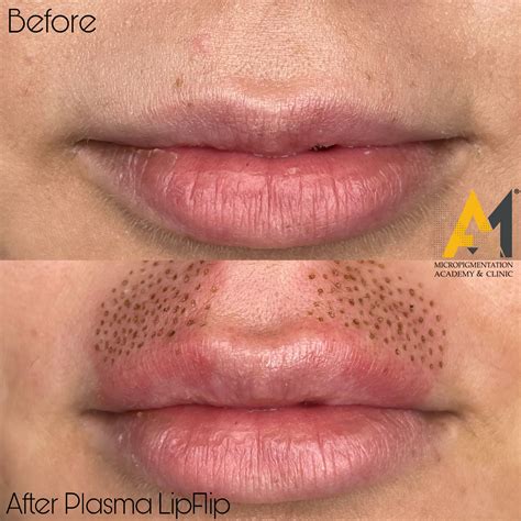 Plasma Fibroblast Lip Flip Before And After Sitelip Org