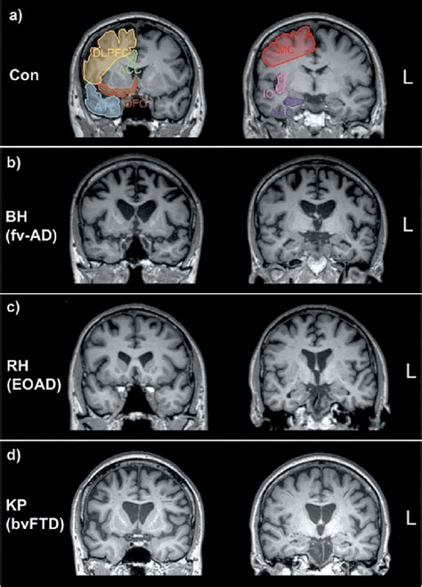 A Age And Sex Matched Control Brain Mri Sections Depicting Regions Of