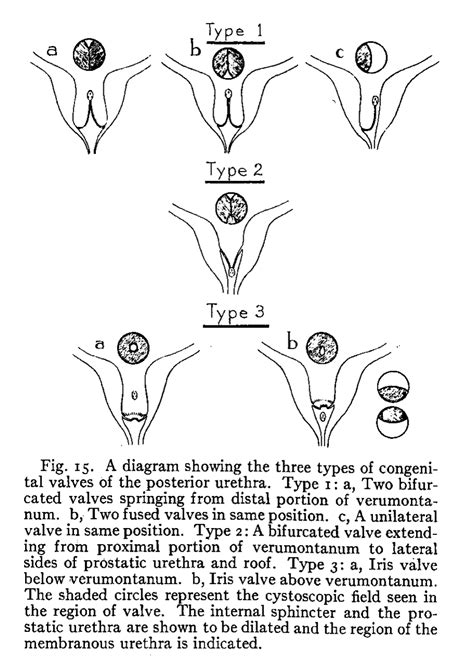 Diagrammatic Representation Of Posterior Urethral Valves