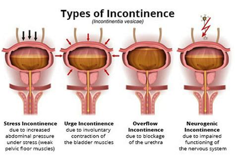 Bladder Dysfunction Life Physio