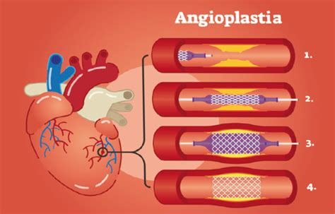 Intervencionismo Cardiaco Qu Es Una Angioplastia Dr Azc Rate