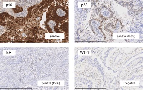 Immunohistochemistry Showed Positivity For P16 Focal Positivity For