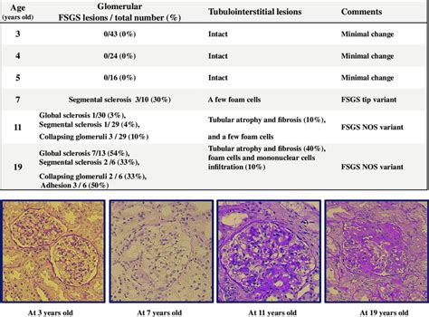 Findings Of Sequential Renal Biopsy In The Patient In The Patient With