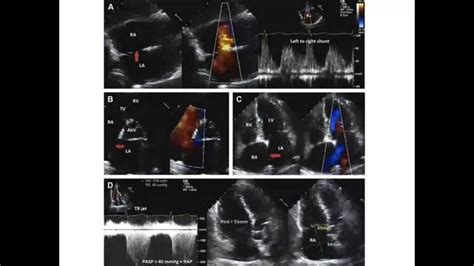 Cardiopathies Cong Nitales Cia Valuation Chographique