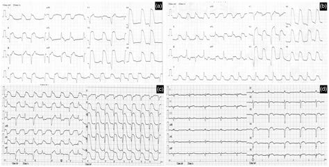 Myocarditis Ecg Changes