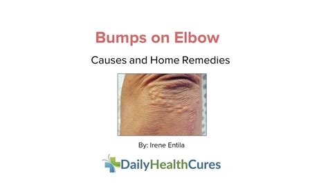 Cluster Of Bumps On Elbow