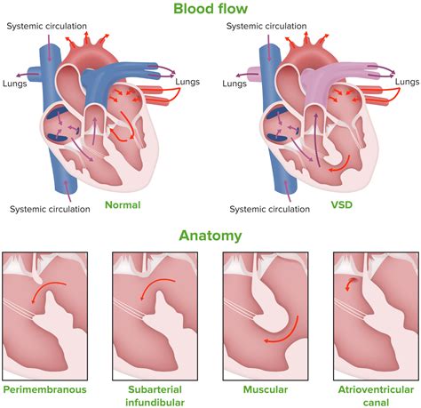 Comunicación Interventricular Civ Concise Medical Knowledge