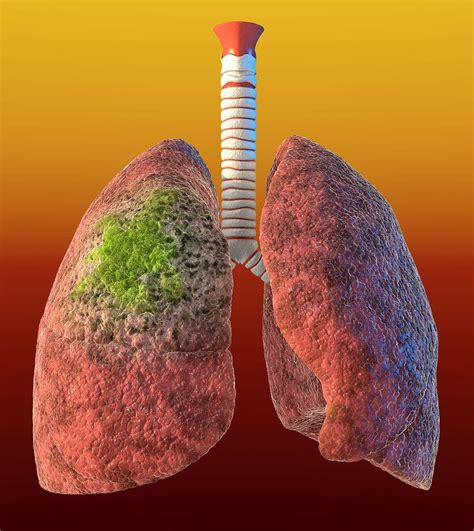 Lung Cancer Photograph By Animated Healthcare Ltdscience Photo Library