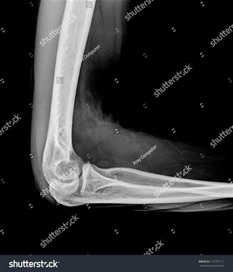 2,861 Elbow xray Images, Stock Photos & Vectors | Shutterstock