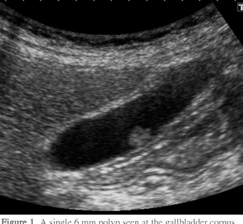 Gallbladder Polyps Ultrasound