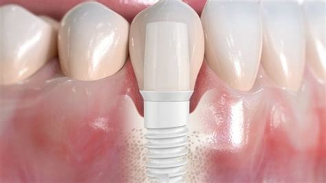 Zirconium Dental Implants In Costa Rica At America Dental Clinic