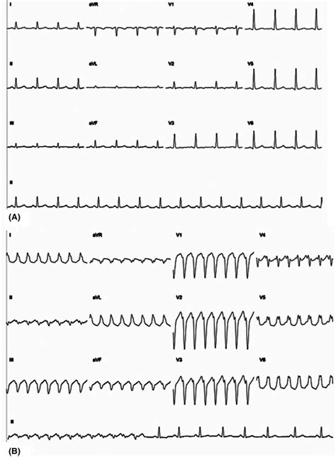 A, 12‐lead electrocardiogram during sinus rhythm. B, 12‐lead ...