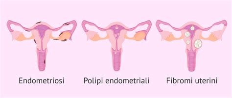 Patologie Che Colpiscono L Endometrio