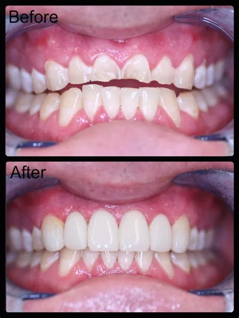 19+ Composite Resin Veneers Before And After at Demax4 | Logdener