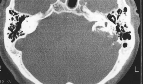 Endolymphatic Sac Tumor And Von Hippel Lindau Disease Imaging Features