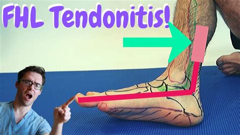 Flexor Hallucis Longus Tendinitis: [Causes, Symptoms & Best Treatment]