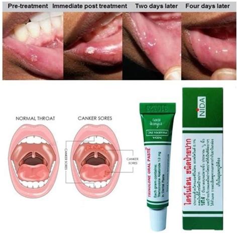 Jual Original Thailand Trinolone Oral Paste 5gr Obat Sariawan