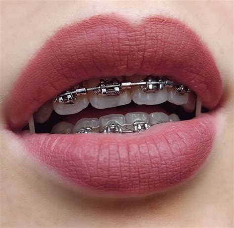 Adult Braces Braces Girls Dental Braces Teeth Braces Cute Braces