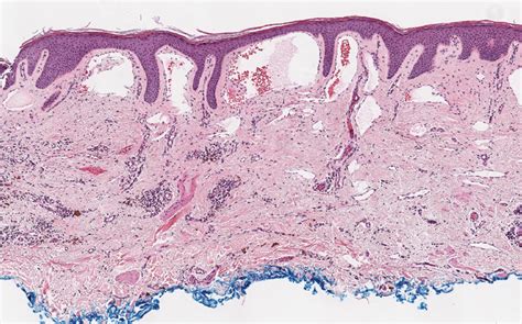 Violaceous Papule With An Erythematous Rim MDedge Dermatology