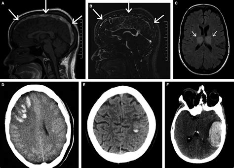 Cerebral Venous Thrombosis Coutinho 2015 Journal Of Thrombosis