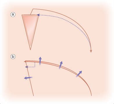 Rotation Flaps Clinical Gate