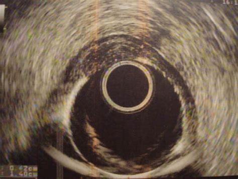 Endoscopic Ultrasonography Revealed A Homogenous Hypoechoic Mass Download Scientific Diagram