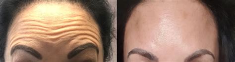 Anti Wrinkle Injections Transform Aesthetics