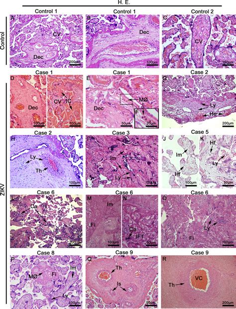 | Placentae histopathology. (A-C) Placentae from non-ZIKV patients ...