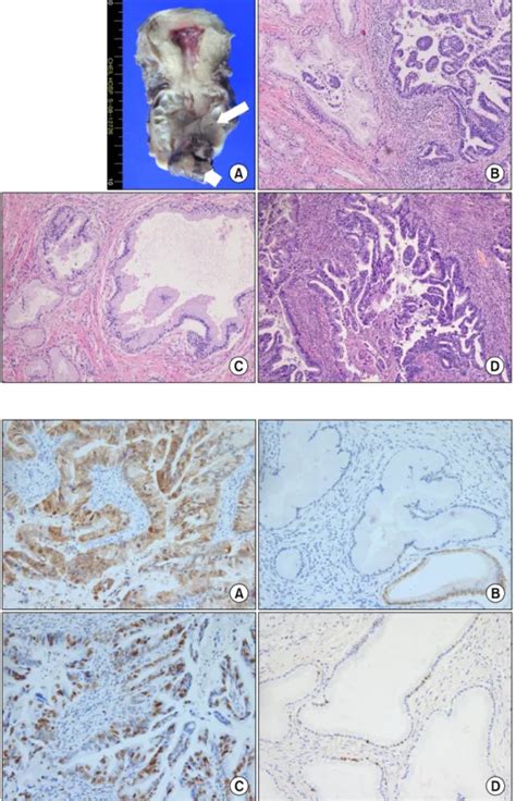 Co Occurrence Of An Adenoma Malignum And An Endocervical Type