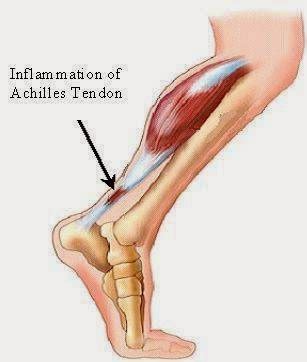 Curar Tendinitis C Mo Saber Que Es Una Tendinitis Y No Otra Cosa