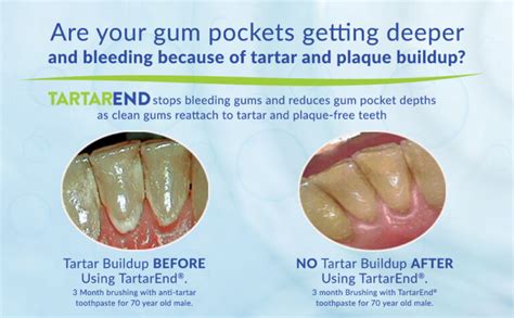 Remove Tartar, Plaque & Dental Calculus | TartarEnd® Toothpaste