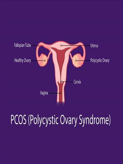 Top 8 Powerful Daily Habits To Reverse Pcospolycystic Ovary Syndrome