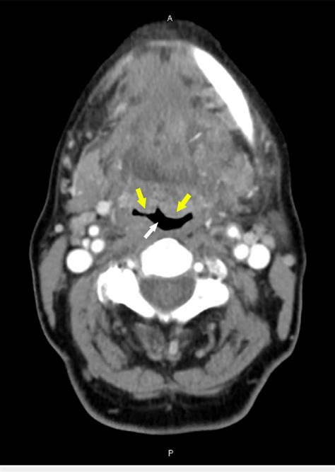 Figure 1 From An Uncommon Case Of Partial Airway Obstruction Due To